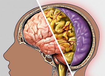 Your Guide to Negligence Claims for Meningitis