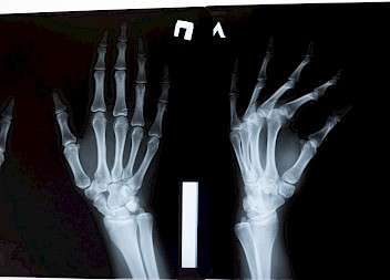 Over £300,000 Won for Unnecessary Wrist Procedure