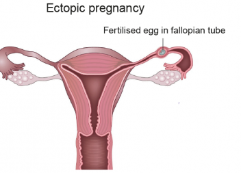 Ectopic Pregnancy