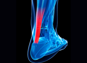 £225,000 Claim for Failed Achilles Rupture Diagnosis