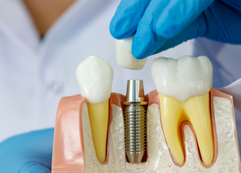 Dental patient awarded £75,000 for failed dental procedures to treat her periodontal disease