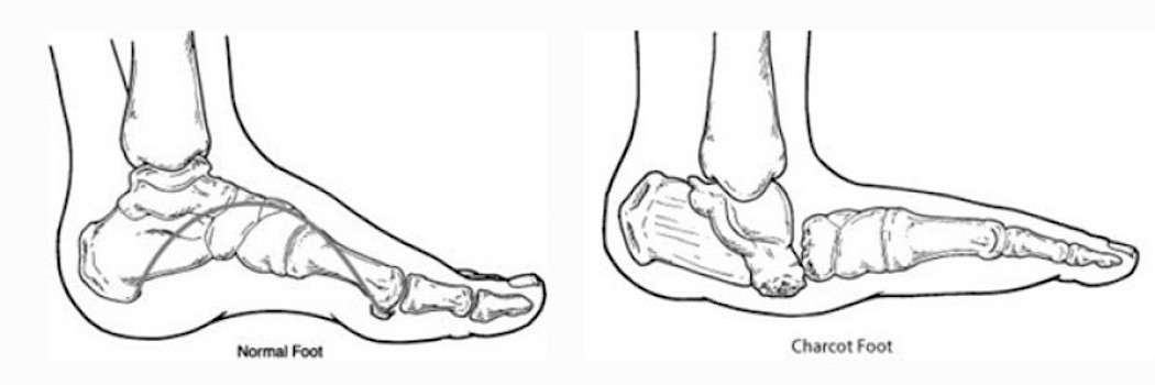 Diagram showing the anatomical difference between a normal foot and a Charcot foot.