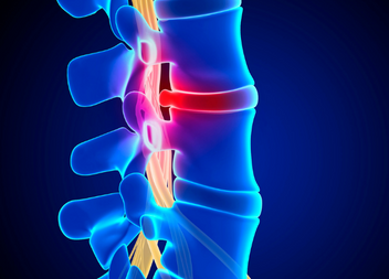 Missed discitis spinal infection leads to six-figure compensation