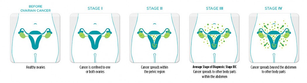 Stages of Ovarian Cancer