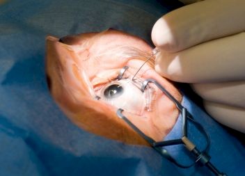 Negligent squint surgery leads to £30,000 compensation