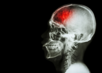 Stroke Cases