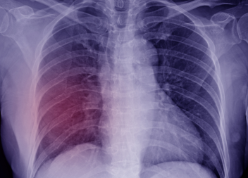 £16,000 Damages for Undiagnosed Rib Fractures that Led to Death