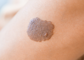 Severe Scarring Following Delayed Skin Cancer Removal