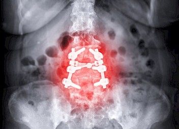 £115,0000 Damages for Nerve Injury During Spinal Surgery