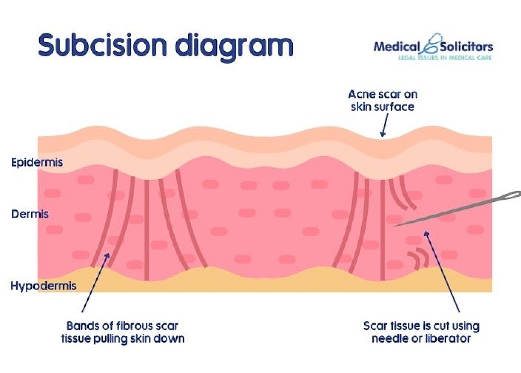 Diagram Explaining the Proccess of Acne Scar Subcision.