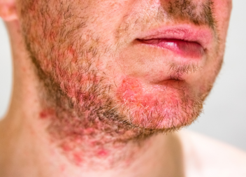 £30,000 for Delayed Diagnosis of Dermatitis Herpetiformis and Coeliac Disease