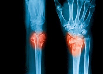 Missed Scaphoid Fracture Cases